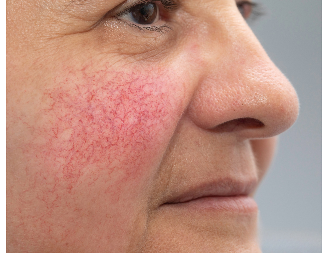 Уход за кожей из розацеа: полный гид для чувствительной кожи