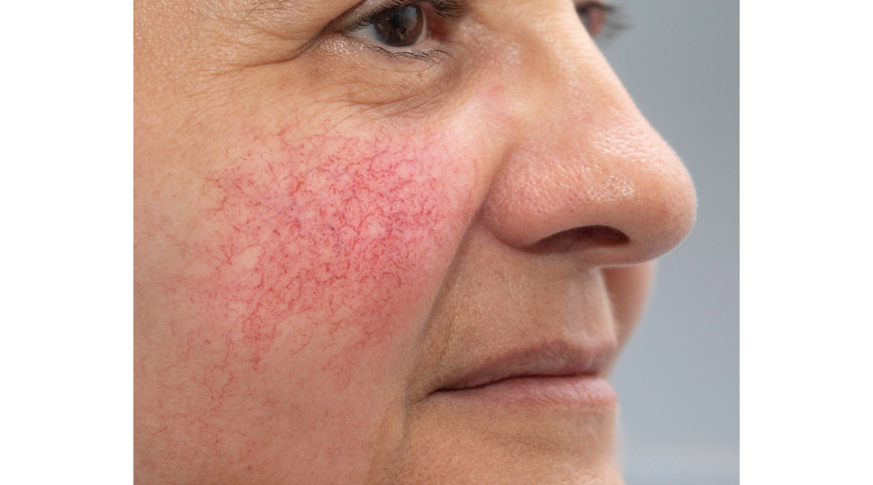 Уход за кожей из розацеа: полный гид для чувствительной кожи