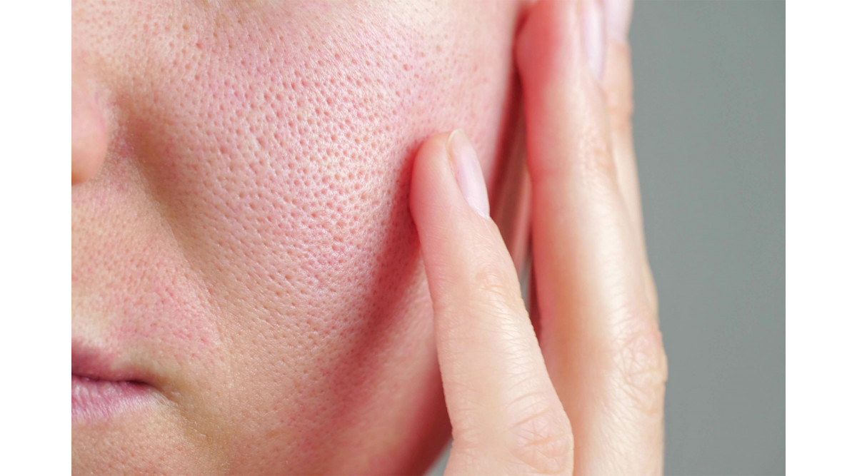 Закупорені пори – причини, методи боротьби з ними