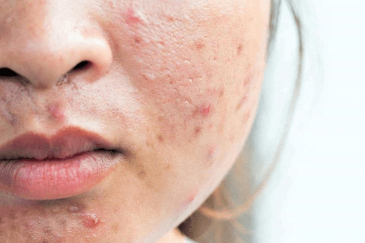 Acne_skin_routine