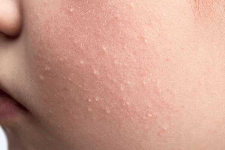 комедони на щоках